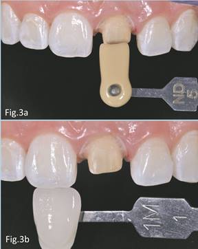 Registro de color de de muñón Figura 3b. Registro de color dentario