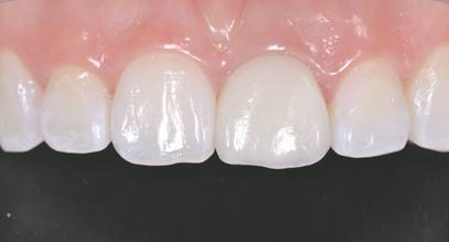 Prueba cerámcia IPS E.max® glaseada