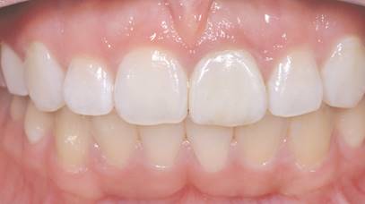 Prótesis unitaria libre de metal integrada a dientes vecinos y antagonistas