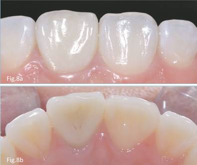 Rehabilitación anterior pieza 2.1 mediante cerámica IPS E.Max® pulida de forma Figura 8b. Vista palatina