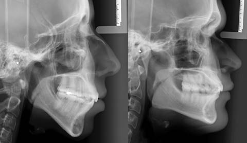 Telerradiograf&iacute;as de perfil de un individuo braquifacial (izquierda) y un dolicofacial (derecha).