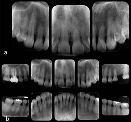 2a. Radiograf&iacute;as periapicales de la zona quir&uacute;rgica. 2b. Serie radiogr&aacute;fica.