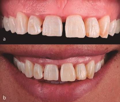 Caracter&iacute;sticas cl&iacute;nicas iniciales 2a. diastema en los centrales superiores, p&eacute;rdida de papilas, discrepancia de los m&aacute;rgenes gingivales en la zona anterosuperior y un biotipo gingival mediana, 2b. l&iacute;nea de la sonrisa alta.