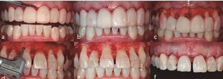 Procedimiento quir&uacute;rgico. 4a. Realizaci&oacute;n de incisiones seg&uacute;n el mock-up. 4b. Incisiones a bisel interno 4c. Levantamiento de colgajo 4d. Ostectom&iacute;a y osteoplastia 4e. Eliminaci&oacute;n de hueso remanente con cincel 4f. Colocaci&oacute;n de sutura.
