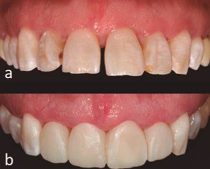 Postoperatorio. 5a Remoci&oacute;n de suturas y vista posquir&uacute;rgica a la semana. 5b Colocaci&oacute;n de provisionales.