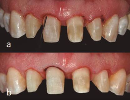a. Recontorneo gingival con electrobistur&iacute; b. Postquir&uacute;rgico a las 9 semanas.