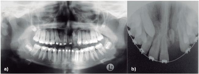 a) Radiografía Panorámica a los 11 años que confirma ausencia de pie-za 2.2. b) Radiografía Oclusal Superior a los 15 años de edad. Control de injerto óseo alveolar en la fisura labio palatina. Se aprecia estabilización de segmentos maxilares, continuidad del arco. Se observa área de menor densidad proyectada en zona de la fisura izquierda y ausencia de pieza 2.2.