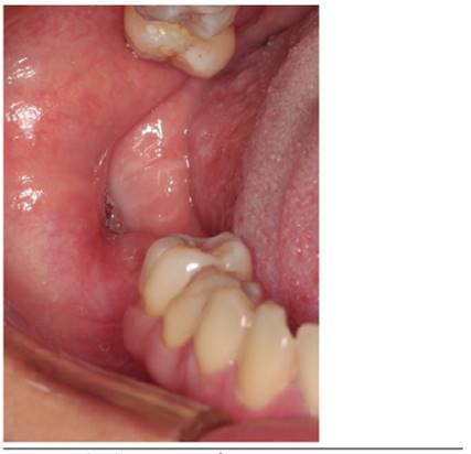 Vista Intraoral de la lesi&oacute;n