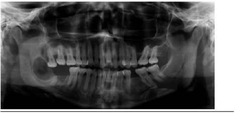 Radiograf&iacute;a Panor&aacute;mica, que muestra la lesi&oacute;n que compromete cuerpo y rama mandibular