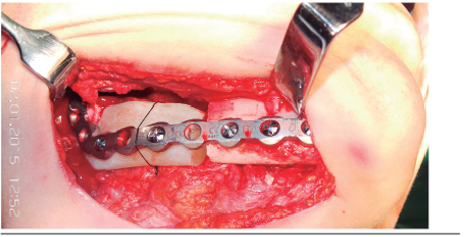 Placa acr&iacute;lica fijada a la placa de reconstrucci&oacute;n