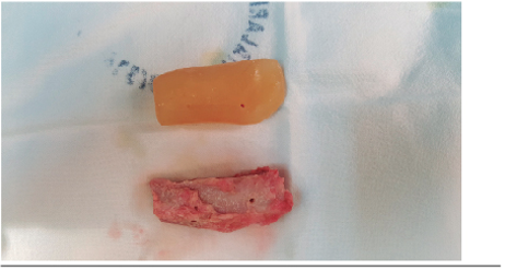 Injerto tallado seg&uacute;n la gu&iacute;a acr&iacute;lica