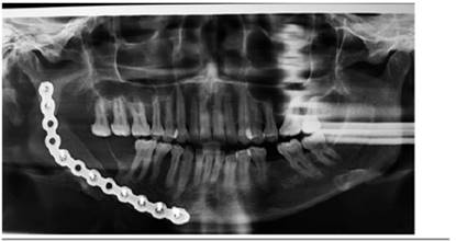 Control radiogr&aacute;fico del injerto