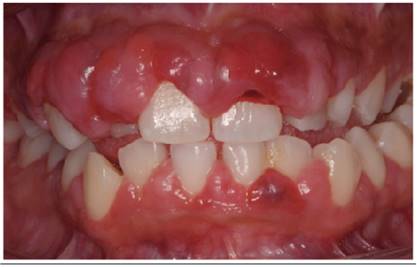 Clinical appearance of phenytoin-associated gingival overgrowth.