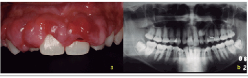 (a) Maxillary aspecto of the initial case. (b) 1. Orthopantomogram radiograph.