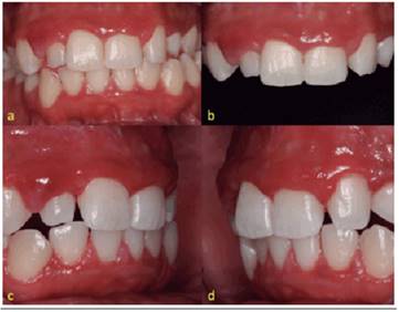 Gingival aspecto to maxillary and mandibular 14.month after initial treatment (a) Frontal view. (b) Approximate maxillary aspcts. (c) Right side view. (d) Left side view. 