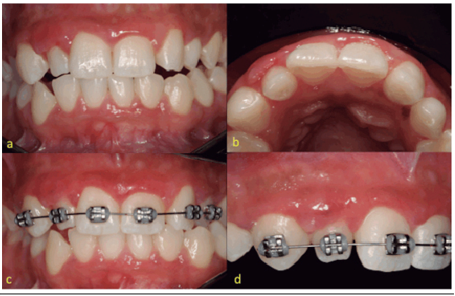 (a) A 24-month periodontal follow-up. (b) Mild hyperplasia in the upper lateral incisor, as a resulto f malpotition. (c) Orthodontic treatment for realingnment and bite descrucing in the upper rigth quadrant. (d) Labial view.