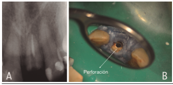 Radiograf&iacute;a preoperatoria con falsa v&iacute;a diente 2.1. 1B. Situaci&oacute;n cl&iacute;nica inical, se observa falsa v&iacute;a en direcci&oacute;n palatina.