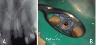 Radiograf&iacute;a con instrumento en falsa v&iacute;a. 2B. Control obturaci&oacute;n y sellado perforaci&oacute;n y falsa v&iacute;a con BIODENTINE. 2C. Imagen cl&iacute;nica de sellado de perforaci&oacute;n y falsa v&iacute;a diente 2.1.