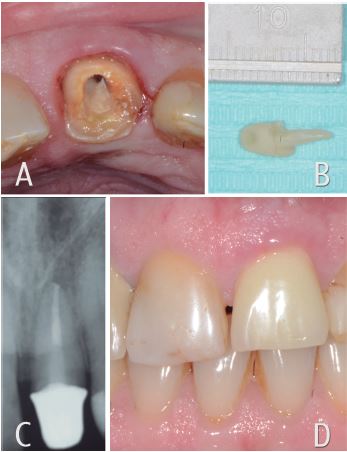 Imagen cl&iacute;nica remanente dentario y sellado de falsa v&iacute;a. 3B. Poste de fibra individualizado. 3C. Control radiogr&aacute;fico 6 meses. 3D. Im&aacute;gen cl&iacute;nica pr&oacute;tesis fija unitaria provisoria diente 2.1
