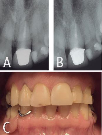 Control radiogr&aacute;fico 12 meses. 4B. Control radiogr&aacute;fico 24 meses. 4C. Situaci&oacute;n cl&iacute;nica 24 meses de pr&oacute;tesis fija unitaria metal cer&aacute;mica.