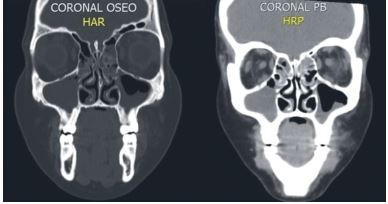Tomograf&iacute;a Axial Computarizada. Corte coronal &oacute;seo (izquierda) y corte coronal de tejidos blandos (derecha).