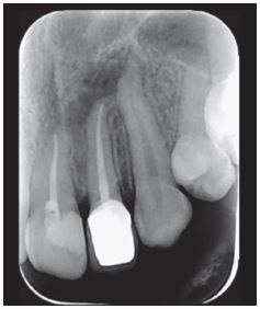 Radiograf&iacute;a periapical. diente 2.2, un mes despu&eacute;s de finalizado el tratamiento.