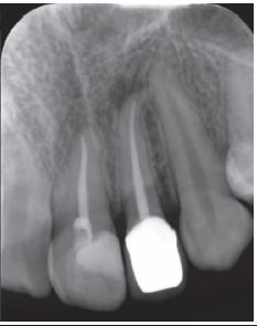 Radiograf&iacute;a periapical. Diente 2.2, seis meses despu&eacute;s de finalizado el tratamiento.