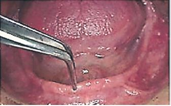 Paciente desdentado total bimaxilar. Mand&iacute;bula presenta gran reabsorci&oacute;n alveolar y fino reborde m&oacute;vil fibroso en zona anterior