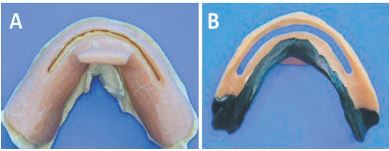 a: Cubeta individual con mango central y ventana espaciada sobre zona de reborde m&oacute;vil. Cobertura completa de papilas retromolares. Se debe recortar y delimitar en boca. b: Cubeta delimitada. Impresi&oacute;n con compuesto de modelar de la zona principal de sellado.