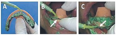 a: Carga de silicona en zona lingual y posterior de la cubeta. b: Relleno de la zona de reborde m&oacute;vil a trav&eacute;s de la ventana (flecha). c: Relleno del borde vestibular (flecha).
