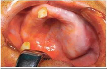 Imagen preoperatoria, se observa la expansión de corticales vestibular y palatina.
