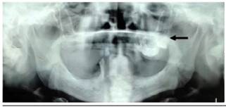 Ortopantomografía preoperatoria, se observa área de densidad mixta en relación a sector posterior de maxilar izquierdo, incluyendo pieza dentaria 2.8