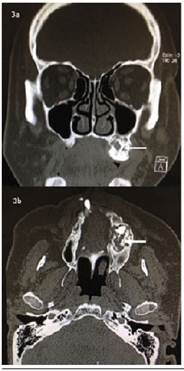3a: Corte coronal de tomografía computada, donde se observan zonas hiperdensas e hipodensas irregulares en su interior, delimitada, en relación a tuberosidad izquierda. 3b: Corte axial de tomografía computada, donde se observa expansión de corticales vestibular y palatina.