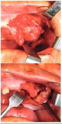 a y b. Imagen intraoperatoria, se observa exéresis de lesión con márgenes libres de lesión.