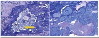 Ambas imágenes muestran Tinción de rojo Congo,(izquierda x 40 y la derecha x 100), de pieza quirúrgica extraída, donde se observa presencia de material amiloide.