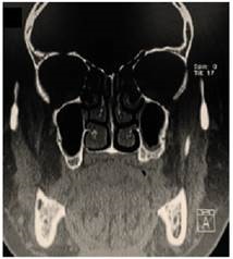 Corte coronal de tomografía computada, donde se observa reparación ósea en relación a zona intervenida.