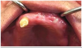 Imagen postoperatoria a 6 meses de realizada la cirugía de resección. Se observa reparación de los tejidos, sin recidivas actuales de la lesión.