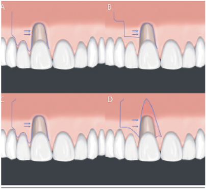 A) Incisión original de acuerdo a Grupe y Warren (1956); B) Diseño de Incisión modificada para proteger el margen gingival, descrita por Grupe (1966); C) Diseño de incisión con una incisión liberadora (cutback), descrita por Corn (1964); D) Diseño de incisión para proteger el margen gingival, descrita por Zucchelli y cols. (2004).