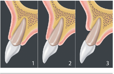 Clasificación de alveolo fresco post exodoncia de 3 tipos: 1) El tejido blando vestibular y la tabla ósea vestibular están a un nivel normal en relación al límite amelocementario del diente pre extraído y permanecen intactos post extracción, 2) El tejido blando vestibular está presente pero la tabla ósea vestibular se ha perdido parcialmente luego de la extracción del diente, 3) El tejido blando vestibular y la tabla ósea vestibular se han perdido luego de la extracción dentaria.