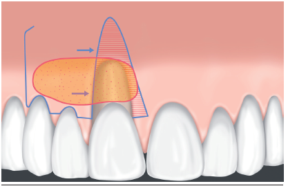 Planificación y diseño de la cirugía propuesta. Se realizó un colgajo desplazado lateral a espesor parcial con injerto de tejido conectivo subepitelial.