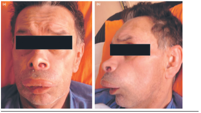 (a) Foto clínica extraoral frontal. (b) Foto clínica extraoral de perfil.