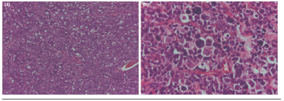 Estudio histopatológico, tinción hematoxilina/eosina. (a) Apariencia de cielo estrellado, aumento 10X. (b) Presencia de células neoplásicas y cuerpos apoptóticos, aumento 40X.