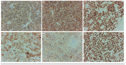 Estudio inmunohistoquímico, contratinción con hematoxilina, aumento 40X, resultados positivos. Positividad para (a) CD20, (b) CD10, (c) bcl-6, (d) MUM-1, (e) c-myc, (f) Ki-67, proliferación positiva para células neoplásicas en más de un 95%.