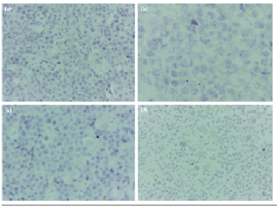 Estudio inmunohistoquímico, contratinción con hematoxilina, aumento 40X, resultados negativosNegatividad para (a) CD30, (b) CD5 (c) blc-2 (d) Hibridación in situ (Cish): EBER