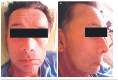Remisión de lesión posterior a tratamiento con TARGA+QT (A) Foto clínica extraoral frontal. (B) Foto clínica extraoral de perfil
