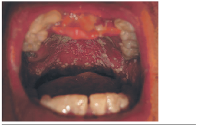 Candidiasis pseudomembranosa posterior a tratamiento con TARGA+QT, foto clínica intraoral.