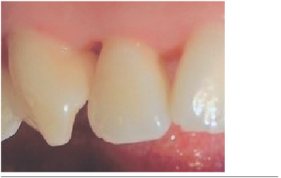 Papila 1. 1-1.2 inicial 