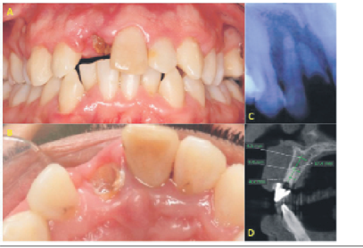 A: Vista frontal de la fractura coronaria en el incisivo central. B: Vista oclusal de la fractura y crecimiento gingival. C. Vista radiográfica del fragmento radicular. D: Vista tomográfica con adecuados ancho y altura para la colocación de implante dental.