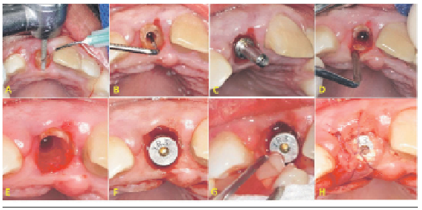 A: Reducción de la porción coronaria de la raíz. B: Primera y segunda perforación con fresa lanza y piloto. C: Verificación del fresado con pin de paralelismo. D: Luxación del fragmento palatino y exodoncia parcial. E: Reducción del fragmento radicular vestibular con fresa redonda. F: Colocación de implante dental a 1mm del fragmento radicular vestibular. G: Colocación e fibrina rica en plaquetas en el espacio entre implante y fragmento radicular. H: Sutura en punto cruzado.