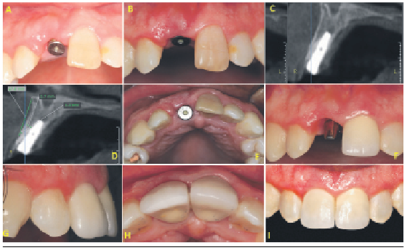 A: Control posoperatorio a los diez días. B: Vista frontal de la apariencia clínica vestibular. C: Vista tomográfica sin anomalías en el fragmento radicular. D: Mediciones de la cortical vestibular preservada. E: Vista oclusal con el cicatrizal colocado. F: Colocación del pilar definitivo. G: Vista lateral de las coronas metal cerámica. H: Vista oclusal de la corona y reborde alveolar. I: Vista frontal de las coronas cementadas.